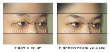 Best Place for Double Eyelid Revision Surgery, Duhan Plastic Surgery - Partial Incision Eye Revision Surgery image 19