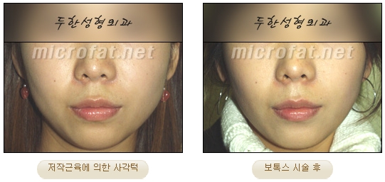 [두한성형외과 보톡스] - [사각턱 보톡스 시술 안내] 관련 이미지 16