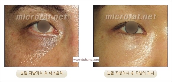 [두한성형외과 경쟁력 미세지방이식] - [타 병원의 지방이식 부작용 교정 - 정교한 마이크로 지방이식, 흡입 안내] 관련 이미지 8