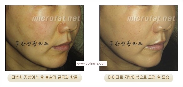 [두한성형외과 경쟁력 미세지방이식] - [볼살, 이마, 측두부 - 안면윤곽 미세지방이식] 관련 이미지 14