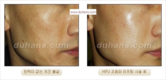 [두한성형외과 경쟁력 주름성형] - [간단하고 부작용 없는 자연스러운 주름제거 방법] 관련 이미지 32