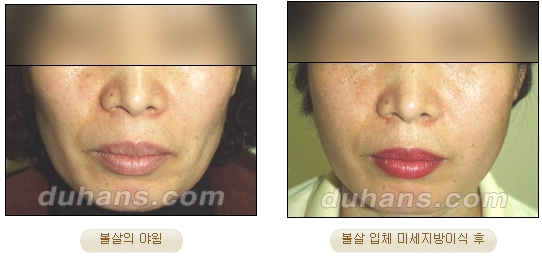 [Duhan Plastic Surgery Facial Autologous Fat Grafting] - [Fat Grafting Guide] image 8