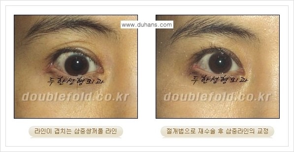 [두한성형외과 경쟁력 쌍꺼풀 재수술] - [삼중 쌍꺼풀 라인의 교정 안내] 관련 이미지 2