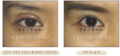Duhan Plastic Surgery Ophthalmic Reoperation - What Is a Successful Double Eyelid Revision Surgery? image 24