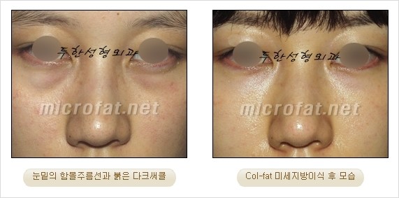 [두한성형외과 경쟁력 눈밑성형] - [Dr. 컬럼 - 눈밑 다크써클의 치료 방법과 치료 효과] 관련 이미지 7