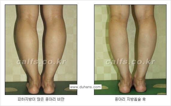 [두한성형외과 경쟁력 멀티종아리성형] - [종아리(다리) 비만 해결 방법 안내] 관련 이미지 7