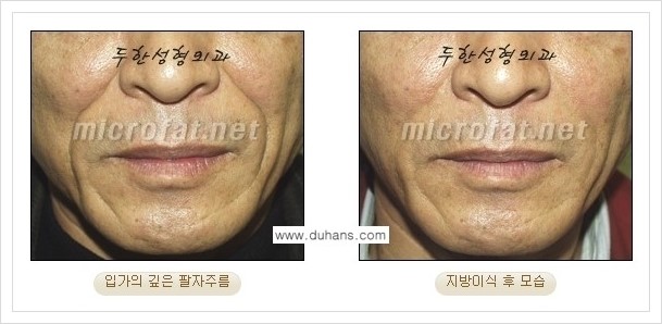 [두한성형외과 경쟁력 미세지방이식] - [입가주름, 팔자주름 교정 안내] 관련 이미지 9