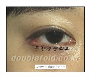 [두한성형외과 경쟁력 쌍꺼풀 재수술] - [Dr. 컬럼 - "재수술의 이상적인 목표"] 관련 이미지 14
