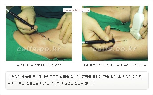 [두한성형외과 경쟁력 멀티종아리성형] -  [종아리 축소술의 여러 가지 종류] 관련 이미지 15