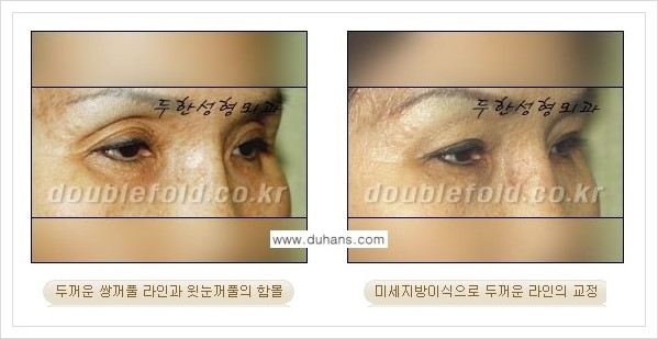 [두한성형외과 경쟁력 눈성형] - [미세지방이식으로 두껍고 어색한 라인 교정 안내 1.] 관련 이미지 11