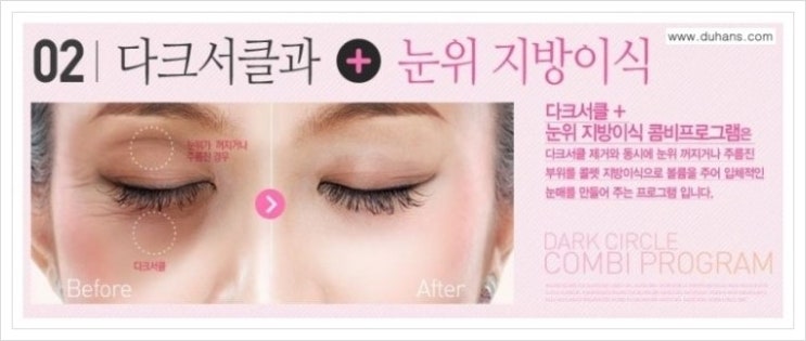 [두한성형외과 경쟁력 다크써클 치료] - [다크써클 + 눈위 지방이식 콤비 프로그램] 관련 이미지 2