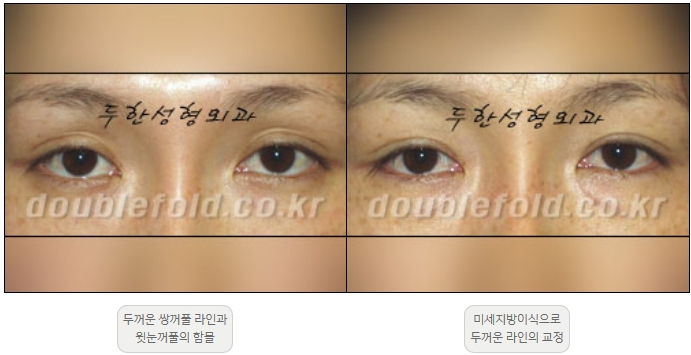 [Duhan Plastic Surgery Double Eyelid Revision] - [Thick Double Eyelid Line] image 23