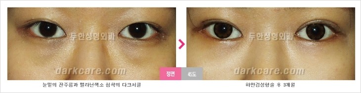 두한성형외과 눈밑수술 - 다크서클 수술 전후 관리 안내 관련 이미지 95