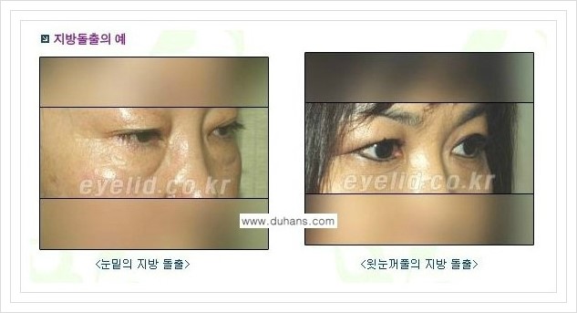 [두한성형외과 경쟁력 지방제거] - [눈꺼풀 지방제거, 눈밑 지방제거] 관련 이미지 1