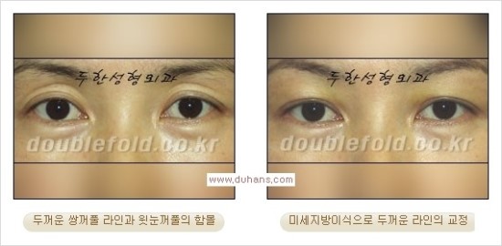 [두한성형외과 경쟁력 눈성형] - [쌍꺼풀 재수술 과정과 쌍꺼풀 재수술 실패의 원인, 쌍꺼풀 재수술의 성공 요건] 관련 이미지 35