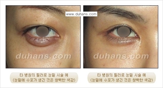 [두한성형외과 주름교정술] - [필러에 대하여 알아야 할 지식] 관련 이미지 9