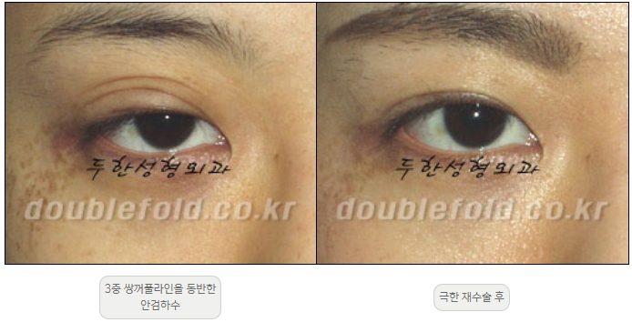 [Duhan Plastic Surgery Double Eyelid Revision] - [Thick Double Eyelid Line] image 49