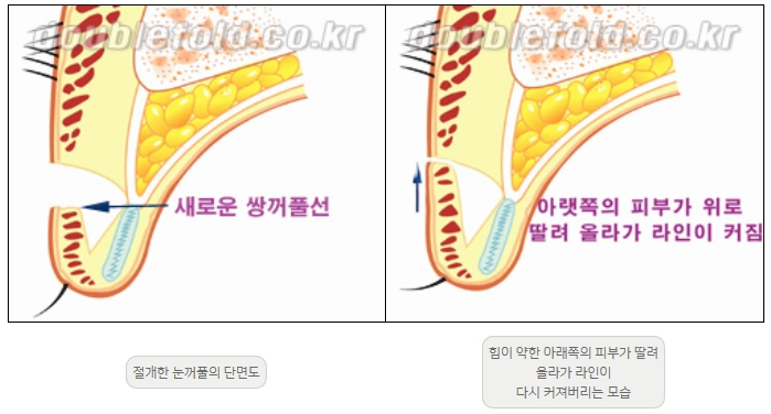 [Duhan Plastic Surgery Double Eyelid Revision] - [Thick Double Eyelid Line] image 5