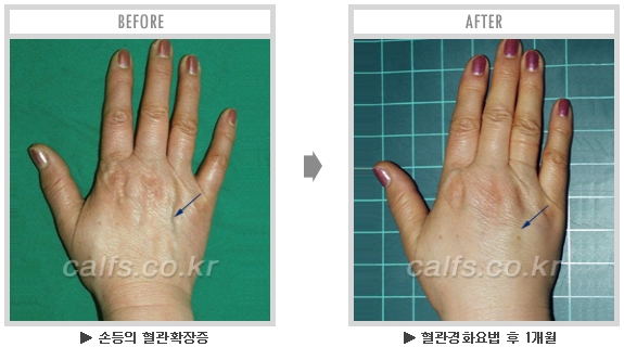 [종아리성형 두한성형외과] - [종아리수술에 대한 자주하는 질문과 답변 모음] 관련 이미지 30