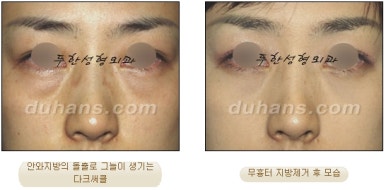 [두한성형외과 지방제거] - [눈두덩이지방제거, 눈밑지방제거] 관련 이미지 39
