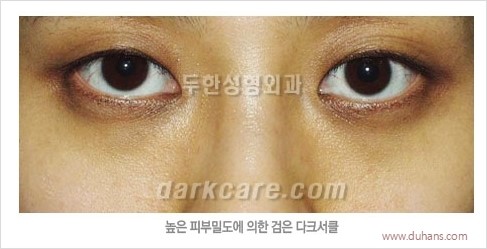 [두한성형외과 경쟁력 눈밑성형] - [다크써클의 원인과 다크써클의 종류] 관련 이미지 15