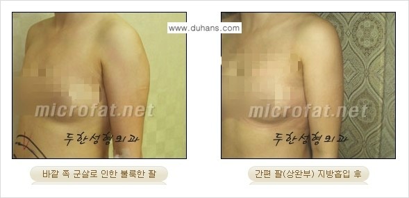 [두한성형외과 간편 지방흡입] - [팔, 팔뚝, 팔뚝살, 상완부 지방흡입 시술의 예] 관련 이미지 3