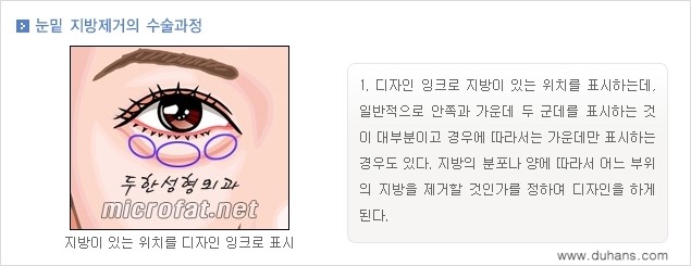 [두한성형외과 경쟁력 "지방제거"] - [눈 지방제거 1.] 관련 이미지 6