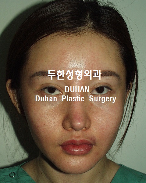 큰 아웃라인,#안검하수 #눈재수술, #애교살 #지방이식 관련 이미지 3