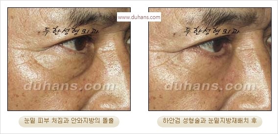 [두한성형외과 경쟁력 안검성형] - [눈밑주름 제거수술] 관련 이미지 10