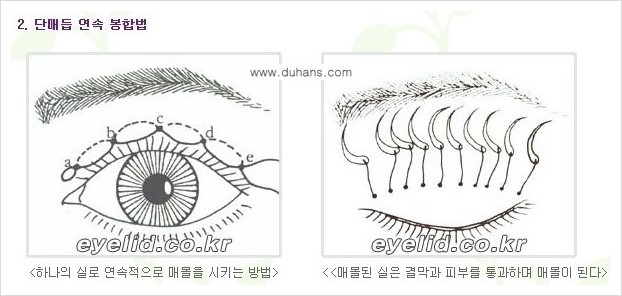[두한성형외과 경쟁력 눈성형] - [절개법, 매몰법의 수술 방법] 관련 이미지 6