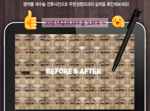 [두한성형외과 쌍커플 재수술] - [비절개눈매교정 재수술] 관련 이미지 45