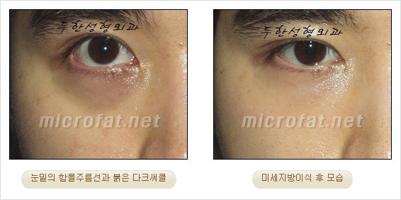 [두한성형외과 경쟁력 눈밑성형 리더] - [윗눈꺼풀 지방제거, 눈밑지방제거, 눈밑지방재배치, 눈밑지방이식 안내] 관련 이미지 22