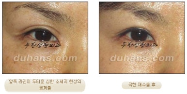 [Special Double Eyelid Revision Surgery at Duhan Plastic Surgery] - [Restorative Surgery for Damaged Double Eyelid Eye Shape] image 4
