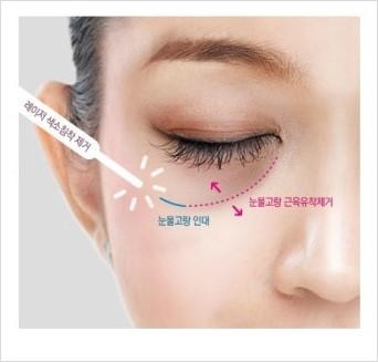 [두한성형외과 경쟁력 눈밑성형] - [눈밑 애교살 시술을 위한 미세지방이식] 관련 이미지 22