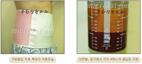 두한성형외과 지방흡입 - 부위별 안전 지방흡입 관련 이미지 11