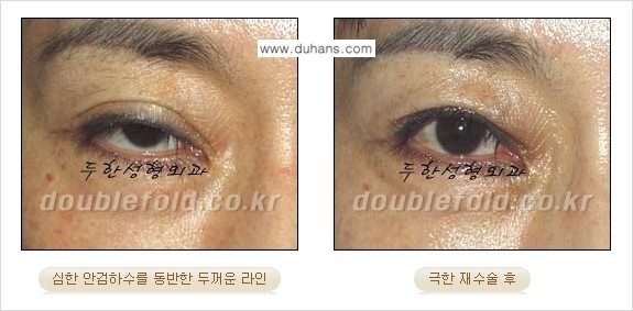 [두한성형외과 NO.1 "극한 눈 재수술"] - [극한 눈 재수술 성공사례 ①] 관련 이미지 4