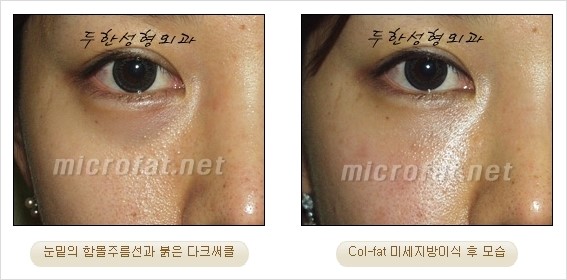​[두한성형외과 경쟁력 눈밑성형 리더] - [눈밑 다크써클의 증상, 원인, 종류, 치료방법 안내] 관련 이미지 20