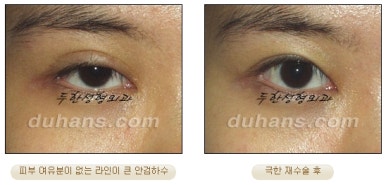 [Special Double Eyelid Revision Surgery at Duhan Plastic Surgery] - [Restorative Surgery for Damaged Double Eyelid Eye Shape] image 22