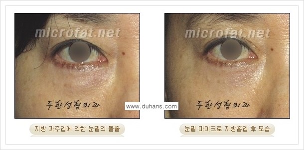[두한성형외과 겨울엔 지방흡입을] - [볼살, 눈밑, 턱선의 초음파 미세지방흡입 1.] 관련 이미지 11