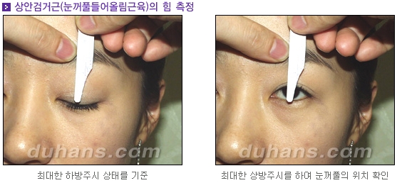 Candidates for Double Eyelid Revision Surgery: Unattractive Double Eyelids, Beautiful Double Eyelids image 4