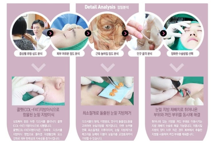 [두한성형외과 경쟁력 눈밑성형] - [다크써클의 종류] 관련 이미지 10