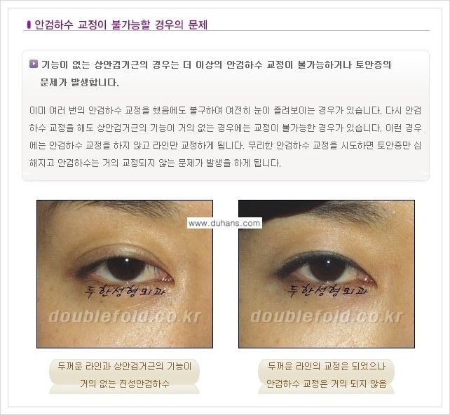 [두한성형외과 경쟁력 쌍꺼풀 재수술(극한 재수술)] - [쌍꺼풀 재수술에서 극복해야 할 여러 가지 상황과 문제점들 안내] 관련 이미지 8