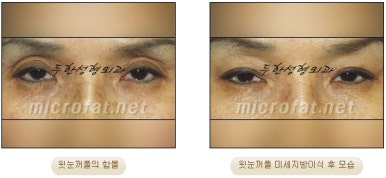 [Doohan Plastic Surgery Autologous Fat Grafting] - [Sunken Eye Fat Grafting] image 14