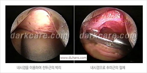 [두한성형외과 경쟁력 주름성형] - [주름제거와 볼륨을 갖게하는 엔도타인 리프팅] 관련 이미지 21