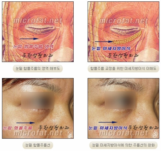 [두한성형외과 지방이식] - [다크서클, 눈밑주름] 관련 이미지 13