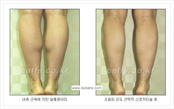 [두한성형외과의 경쟁력 멀티 종아리성형] - [근육퇴축을 위한 초음파 유도 선택적 신경차단술 안내] 관련 이미지 6