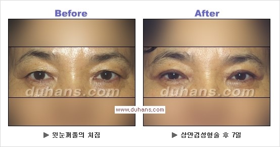 [두한성형외과 경쟁력 안검성형] - [젊고 아름다운 눈매 상안검 성형술 안내] 관련 이미지 9
