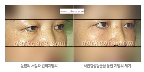 [두한성형외과 경쟁력 눈밑성형] - [눈밑 안와지방 돌출의 무통마취 무흉터 눈밑지방제거 안내] 관련 이미지 10