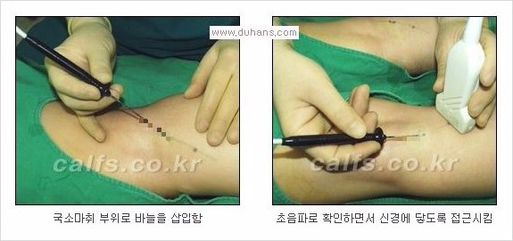 [두한성형외과 Dr. 컬럼 - 타 병원의 종아리 퇴축술 이후 문제가 발생한 경우] 관련 이미지 7