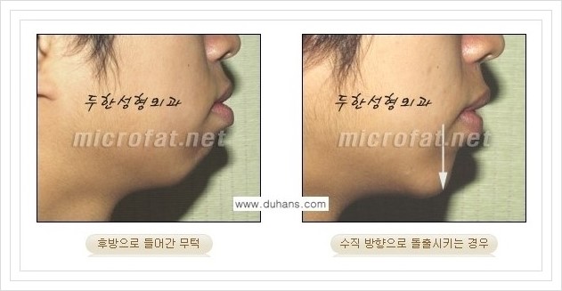 ⁠⁠[두한성형외과 경쟁력 미세지방이식] - [턱 미세지방이식 - 안면윤곽 교정 안내] 관련 이미지 5